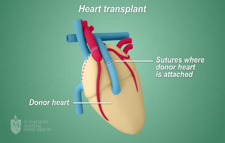 A Few Things to Know About Heart Transplants | Simplyhealtharticles.com