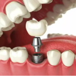 Dental Implants