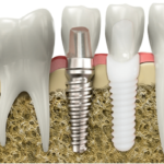 Dental Implants Success