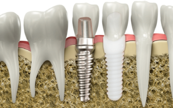 Dental Implants Success