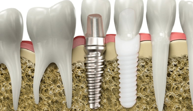 Dental Implants Success