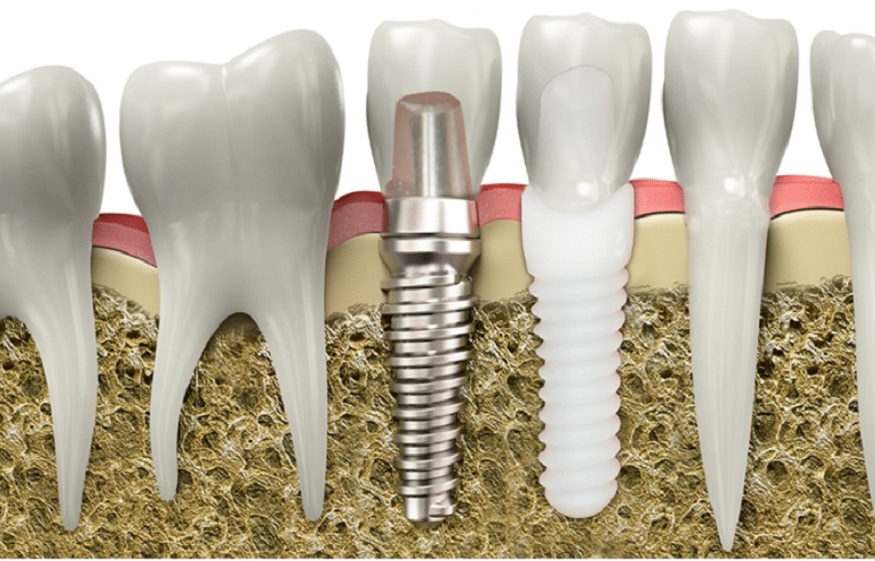 How Nutrition Plays a Role in Dental Implants Success