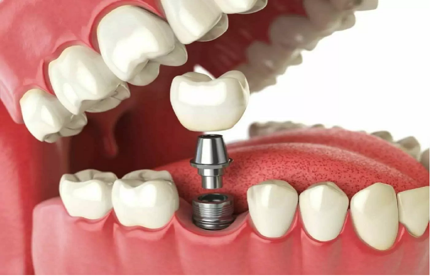 The Complete Guide to Full Dental Implants Cost in Australia