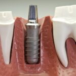 Titanium Dental Implants