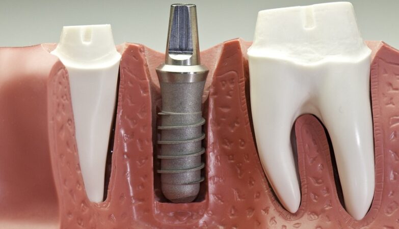 Titanium Dental Implants