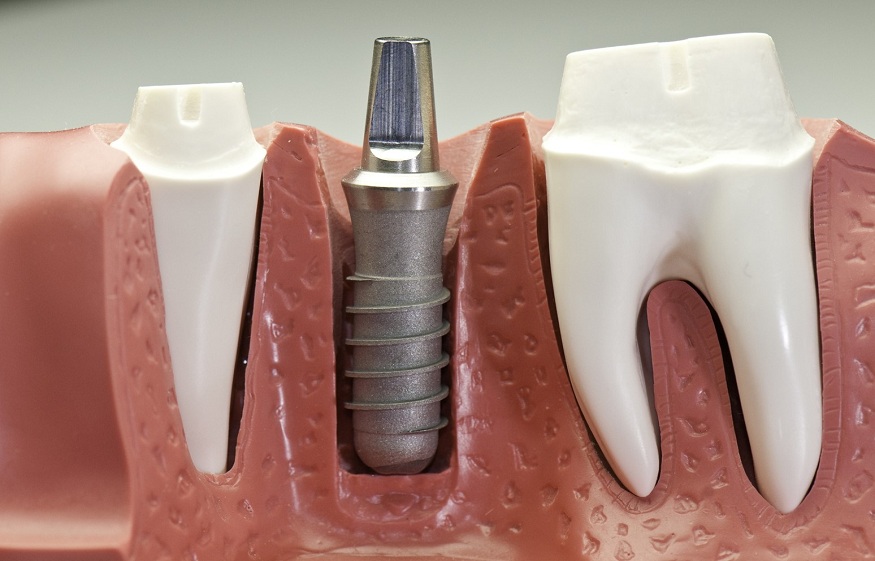 Titanium Dental Implants for Athletes: The Best Tooth Replacement for Active Lifestyles