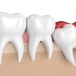 Wisdom teeth removal Melbourne