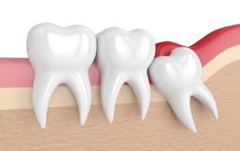 Wisdom teeth removal Melbourne