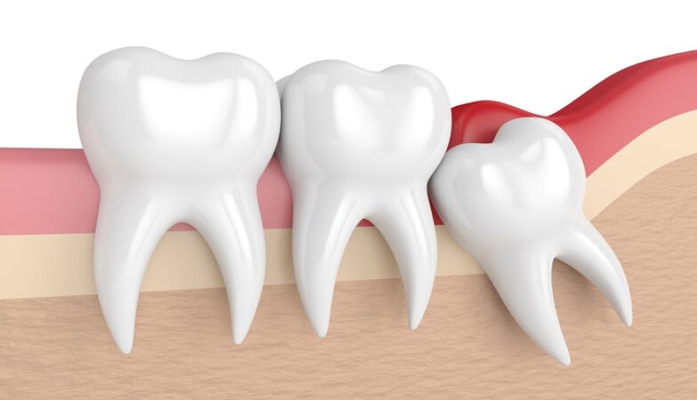 Wisdom teeth removal Melbourne