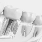 dental implants Sydney