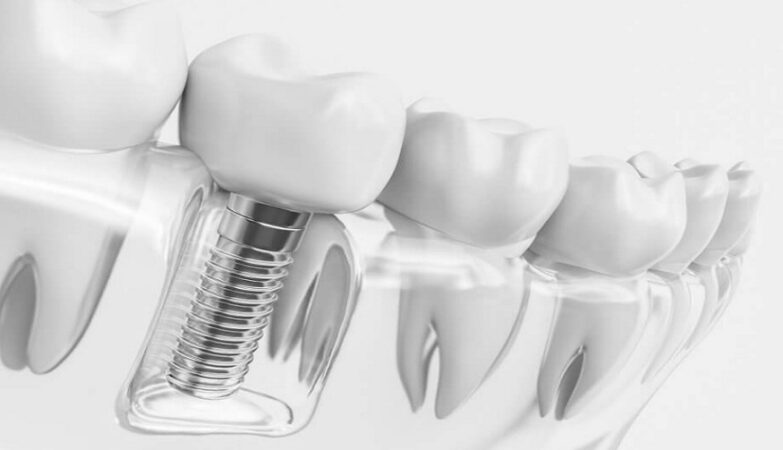 dental implants Sydney