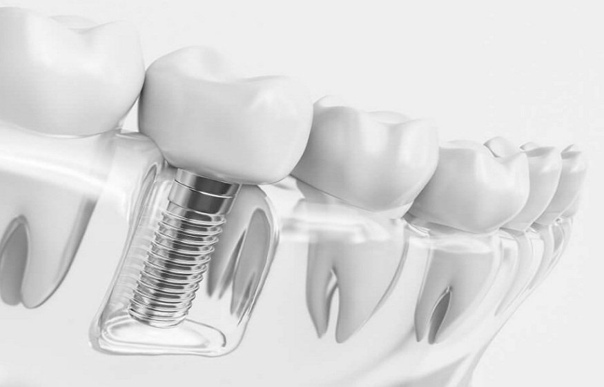 The Lifespan of Dental Implants: How Long Do They Last