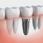 dental implants cost in Melbourne,