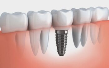 dental implants cost in Melbourne,