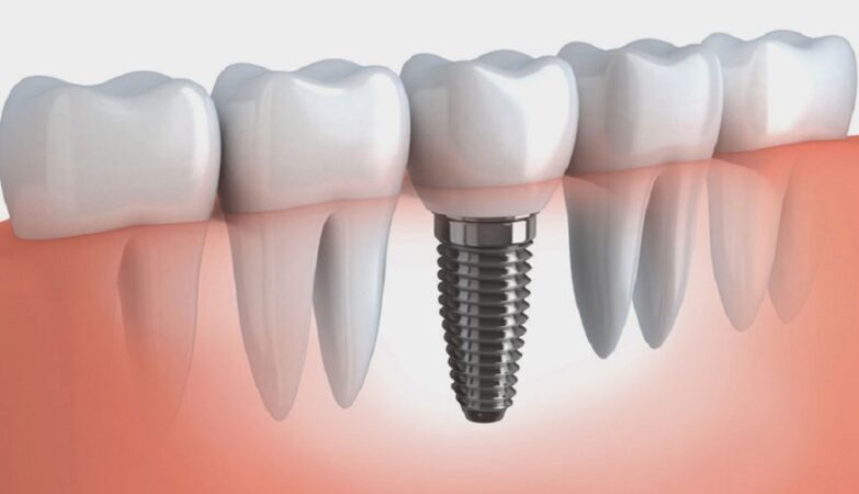 dental implants cost in Melbourne,