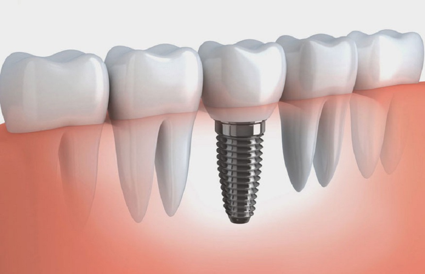 Why All-on-4 Dental Implants Are a Game-Changer for Full-Mouth Restoration